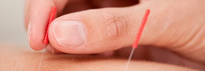 acupuncture